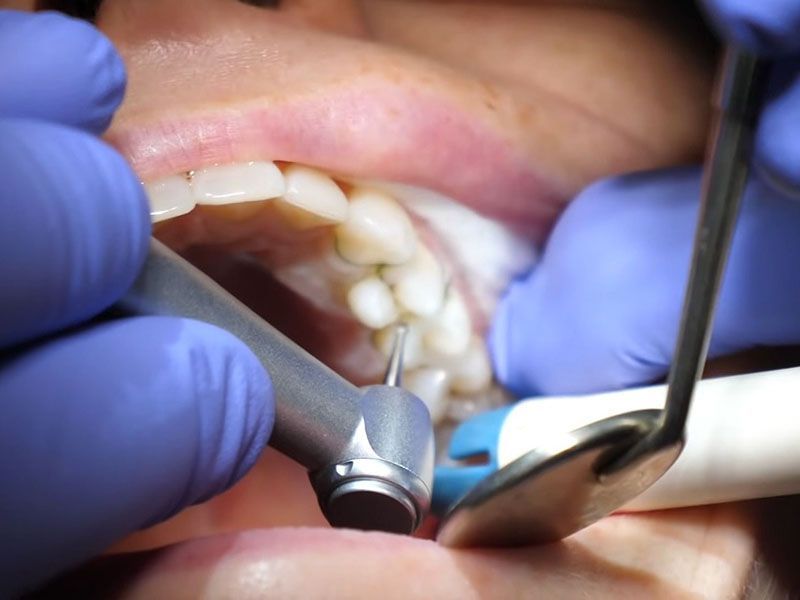 Удаление кисты зуба: советы по уходу