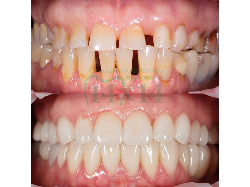 Керамические коронки и виниры на зубах и имплантатах