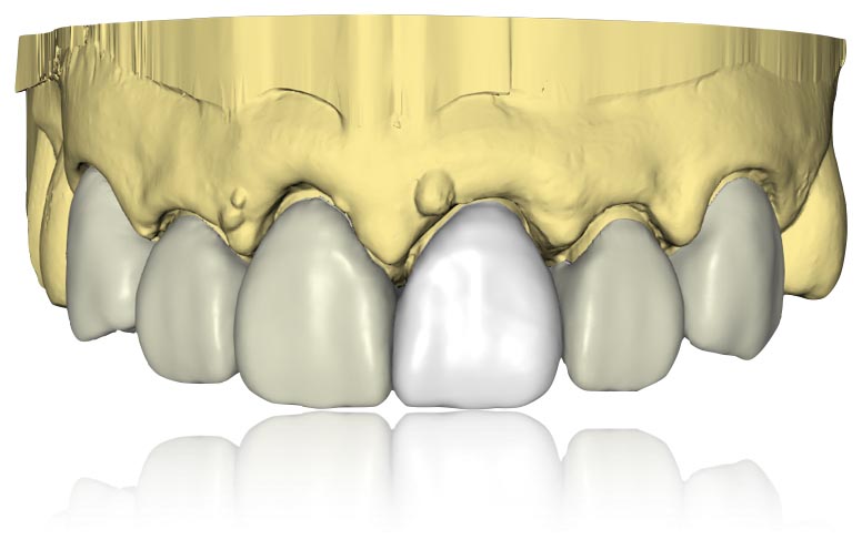 Cerec Cerec