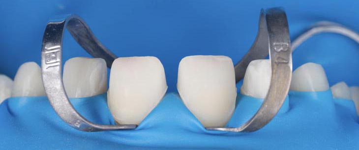 Изоляция зубов перед фиксацией виниров