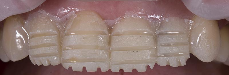 Маркировка глубины стачивания зубов